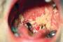 Oral Diseases