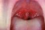 Strep Throat