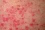 Skin Rashes