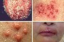 Herpes