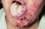 mouth sores