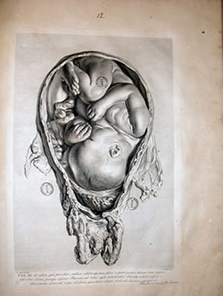 William Hunter (1718-1783). Anatomia uteri humani gravidi tabulis illustrate. . . the anatomy of the human gravid uterus exhibited in figures. John Baskerville, Birmingham, 1774.