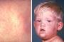 Childrens Diseases