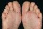 Foot Problems
